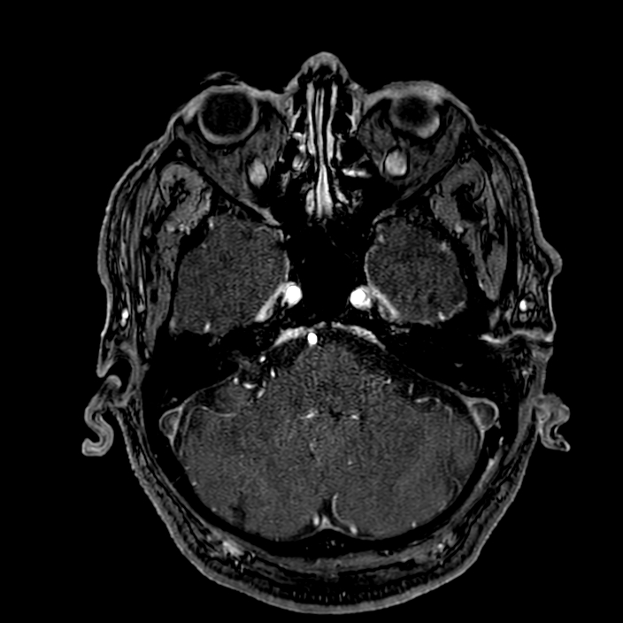 Accessory middle cerebral artery (Radiopaedia 73114-83828 Axial MRA 35).jpg