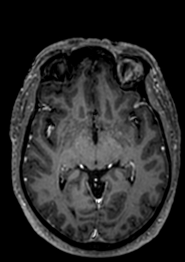 File:Accessory middle cerebral artery (Radiopaedia 73114-83828 Axial T1 C+ 54).jpg