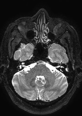 File:Accessory middle cerebral artery (Radiopaedia 73114-83828 Axial T2 164).jpg