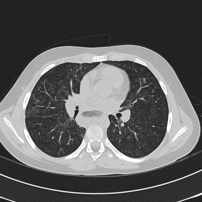 Achalasia (Radiopaedia 14946-14878 Axial lung window 37).jpg