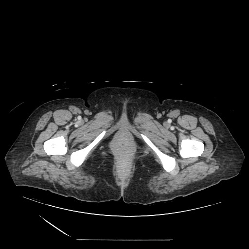 File:Acinar cell carcinoma of the pancreas (Radiopaedia 75442-86669 Axial C+ portal venous phase 157).jpg