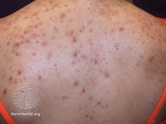 File:Acne affecting the back images (DermNet NZ acne-acne-back-182).jpg