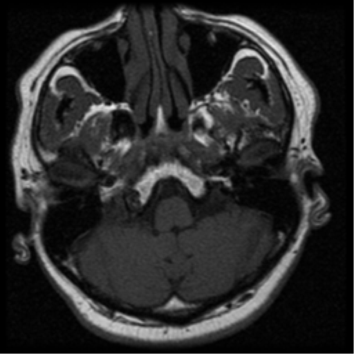 File:Acoustic schwannoma (Radiopaedia 33045-34060 Axial T1 4).png