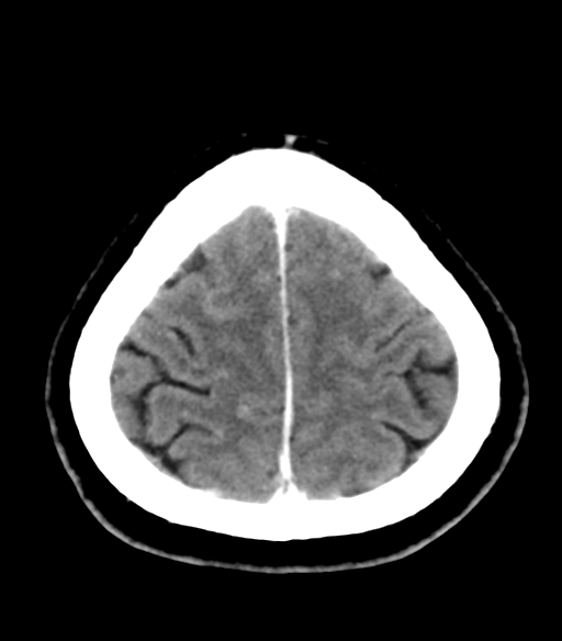 File:Acoustic schwannoma (Radiopaedia 33045-34065 Axial C+ delayed 24).png
