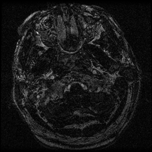 File:Acoustic schwannoma (Radiopaedia 39170-41387 Axial FIESTA 6).png