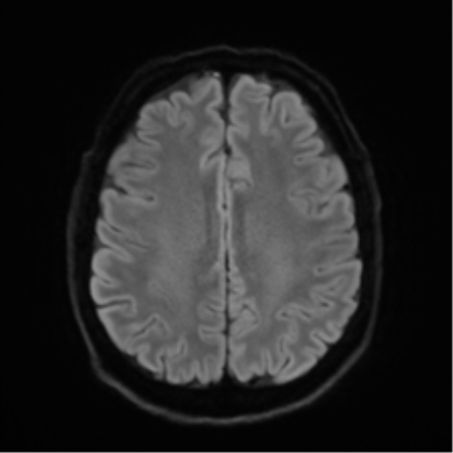 Acoustic schwannoma (Radiopaedia 50846-56358 Axial DWI 48).png