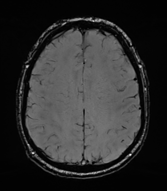 Acoustic schwannoma (Radiopaedia 50846-56358 Axial SWI 65).png