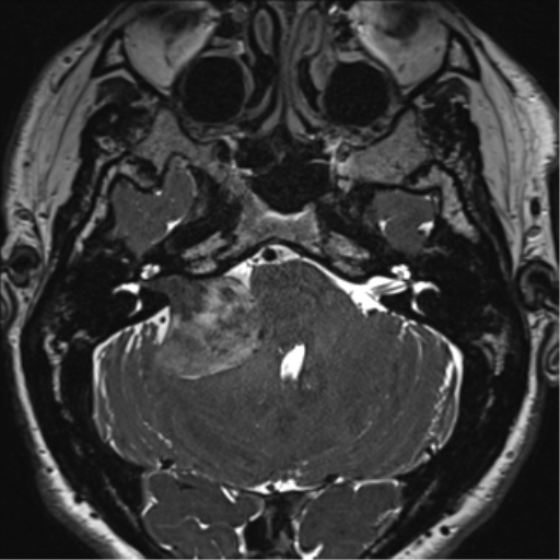 File:Acoustic schwannoma (Radiopaedia 50846-56358 Axial T2 20).png