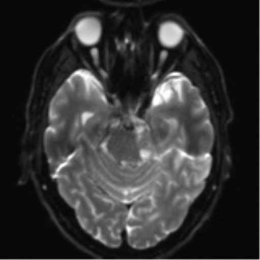 Acoustic schwannoma (Radiopaedia 55729-62281 E 8).png