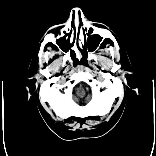 File:Acoustic schwannoma - cystic (Radiopaedia 29487-29980 AXIAL THICK non-contrast 2).jpg