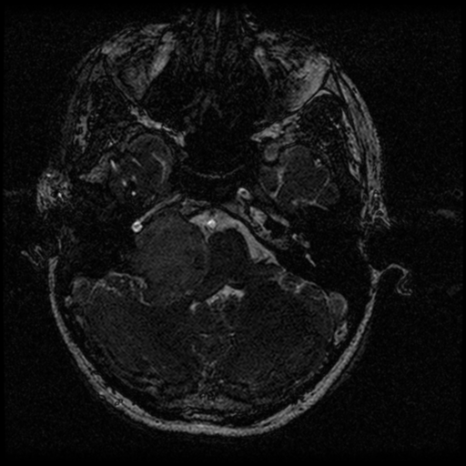 Acoustic schwannoma - eroding petrous apex (Radiopaedia 39674-42004 Axial T2 25).png