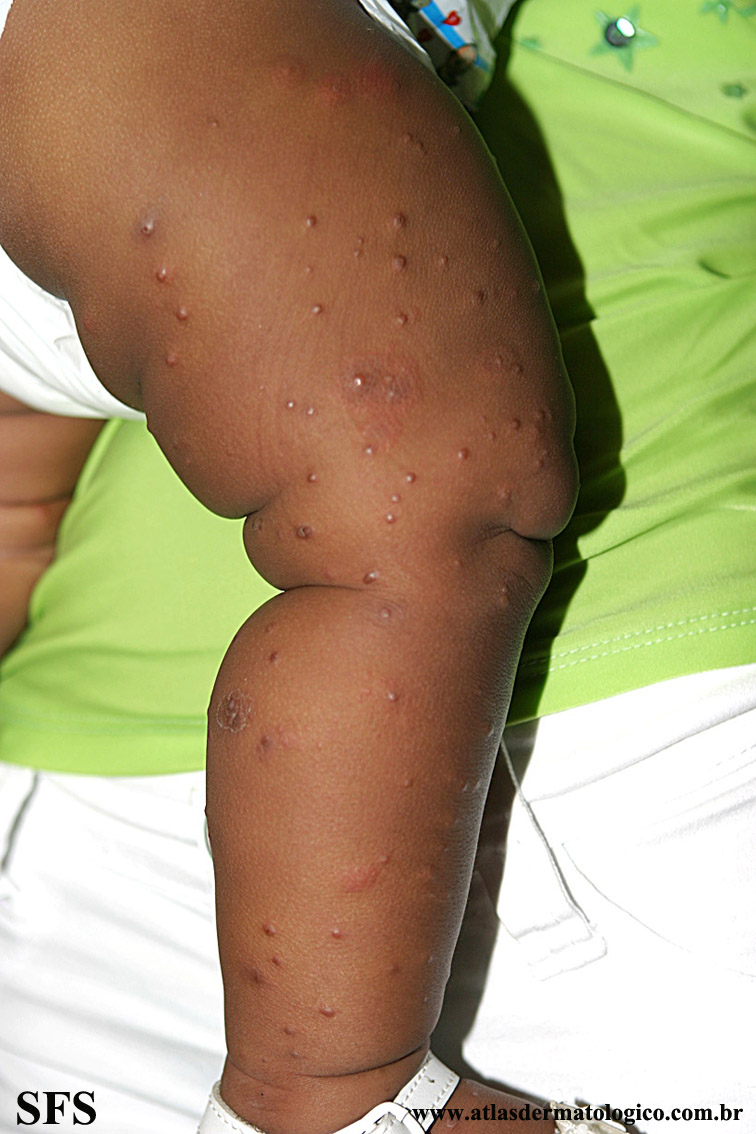 Acrodermatitis Infantile Papular (Dermatology Atlas 30).jpg