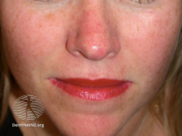 Actinic Keratoses treated with imiquimod (DermNet NZ lesions-ak-imiquimod-3737).jpg