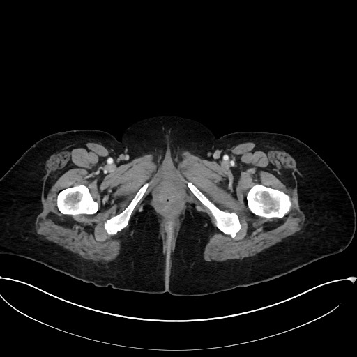 Active Crohn disease (Radiopaedia 59394-66750 Axial C+ portal venous phase 76).jpg