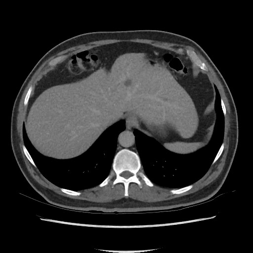 File:Active colonic bleed on CT (Radiopaedia 49765-55025 Axial C+ delayed 14).jpg