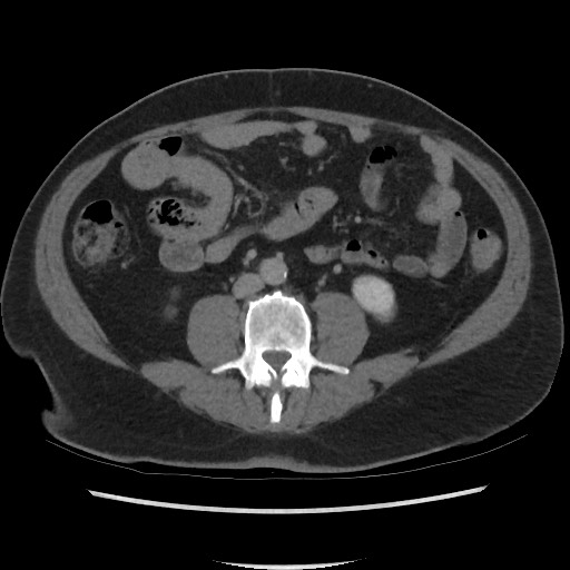 File:Active colonic bleed on CT (Radiopaedia 49765-55025 Axial C+ delayed 46).jpg
