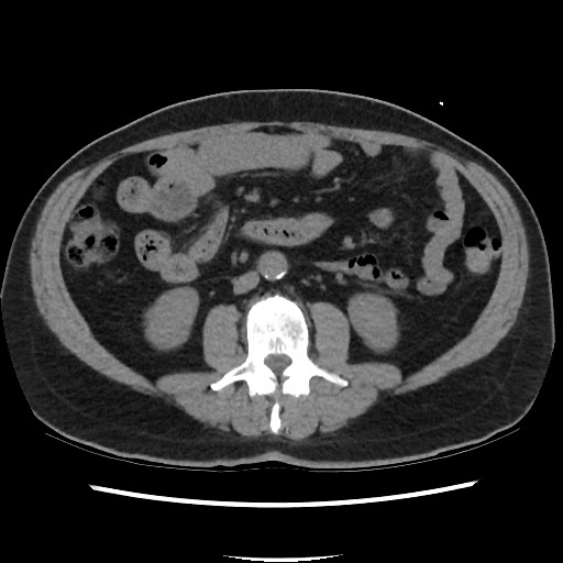 File:Active colonic bleed on CT (Radiopaedia 49765-55025 Axial non-contrast 40).jpg