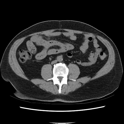 Active colonic bleed on CT (Radiopaedia 49765-55025 Axial non-contrast 46).jpg