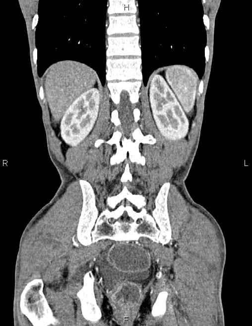 Active crohn disease (Radiopaedia 87133-103397 Coronal C+ arterial phase 52).jpg
