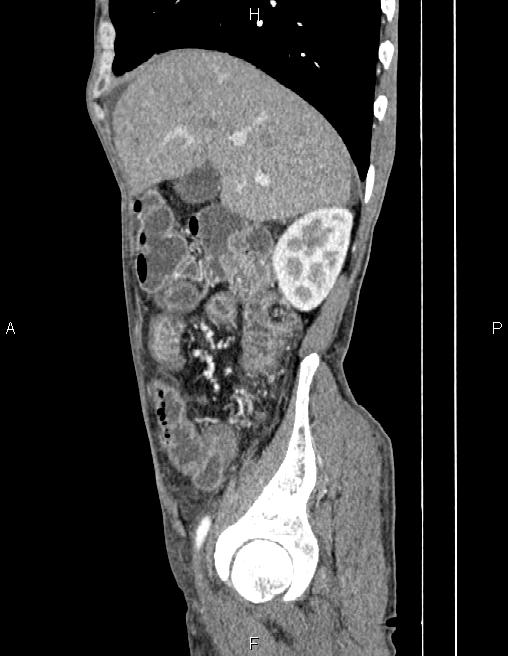 Active crohn disease (Radiopaedia 87133-103397 Sagittal C+ arterial phase 21).jpg