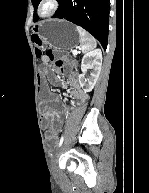 Active crohn disease (Radiopaedia 87133-103397 Sagittal C+ arterial phase 65).jpg