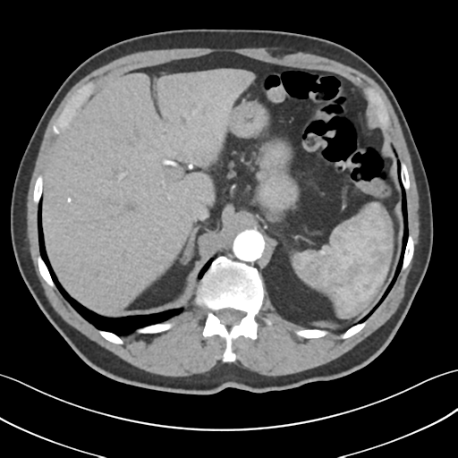 File:Active diverticular hemorrhage (Radiopaedia 39415-41725 Axial C+ arterial phase 14).png