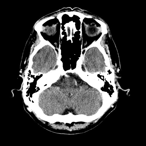 File:Active neurocysticercosis before and after therapy (Radiopaedia 71710-82099 Axial C+ delayed 82).jpg