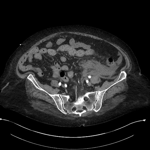 File:Active renal extravasation with large subcapsular and retroperitoneal hemorrhage (Radiopaedia 60975-68796 Axial C+ arterial phase 141).jpg