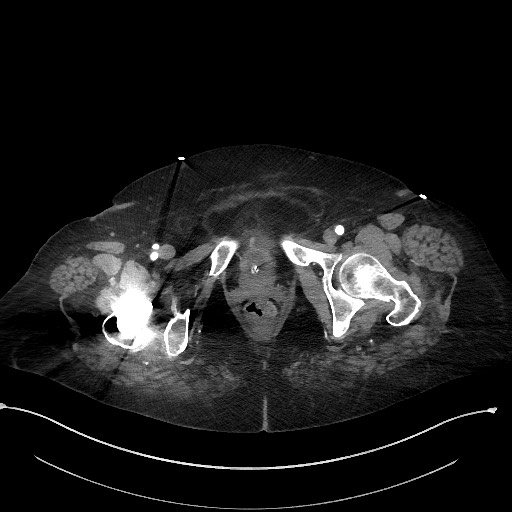 Active renal extravasation with large subcapsular and retroperitoneal hemorrhage (Radiopaedia 60975-68796 Axial C+ arterial phase 194).jpg
