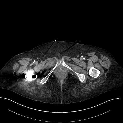 Active renal extravasation with large subcapsular and retroperitoneal hemorrhage (Radiopaedia 60975-68796 Axial C+ arterial phase 209).jpg