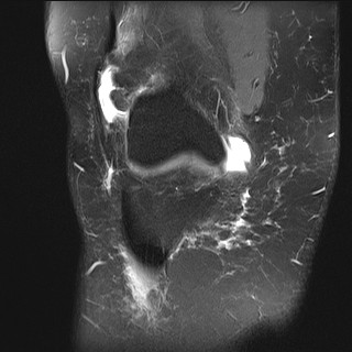 File:Acute-on-chronic transient lateral patellar dislocation with trochlear dysplasia (Radiopaedia 84099-99349 Coronal PD fat sat 29).jpg