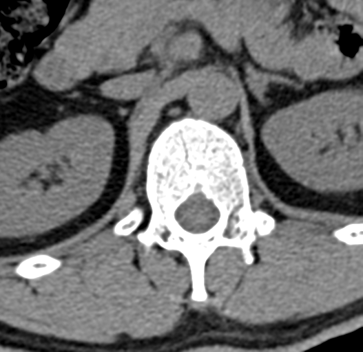 File:Acute L1 burst compression fracture (Radiopaedia 34430-35755 Axial non-contrast 12).png