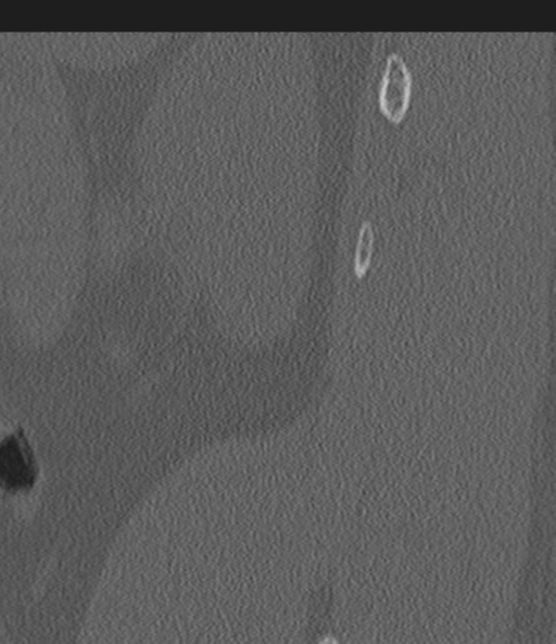 Acute L1 burst compression fracture (Radiopaedia 34430-35755 Sagittal bone window 64).png
