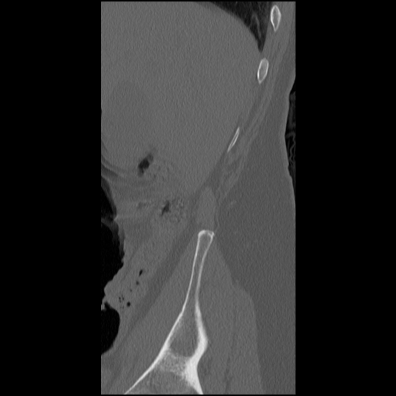Acute Schmorl's node (Radiopaedia 83276-102365 Sagittal bone window 76).jpg