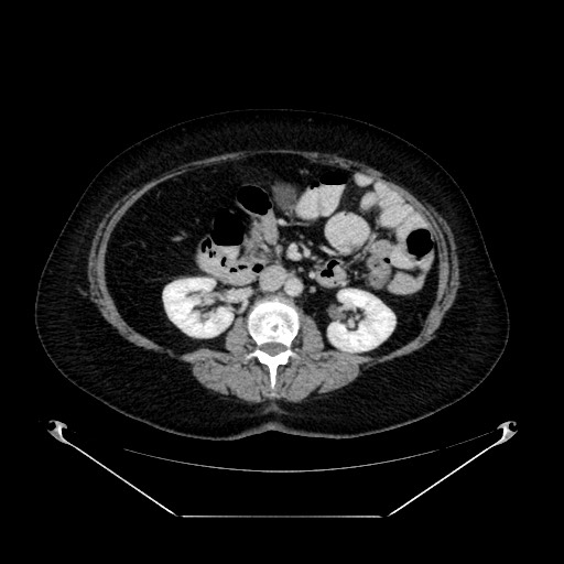 Acute appendicitis, heterotaxy syndrome (Radiopaedia 66884-76202 Axial C+ portal venous phase 56).jpg
