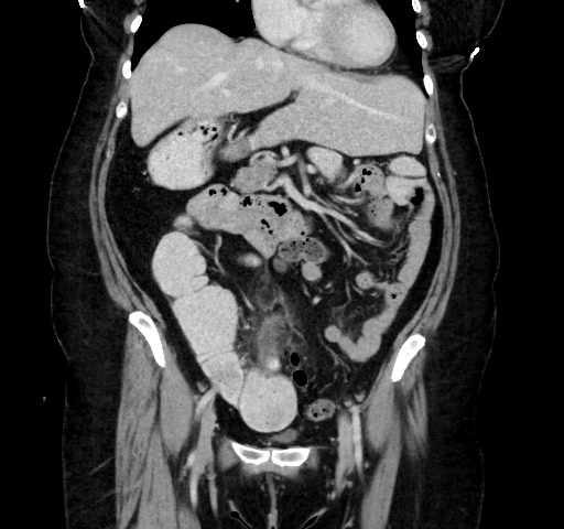 Acute appendicitis, heterotaxy syndrome (Radiopaedia 66884-76202 Coronal C+ portal venous phase 49).jpg