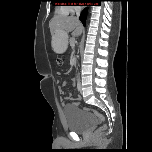 File:Acute appendicitis (Radiopaedia 10498-10973 Sagittal C+ portal venous phase 31).jpg