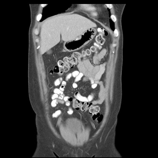 File:Acute appendicitis (Radiopaedia 30297-30934 Coronal C+ portal venous phase 11).jpg