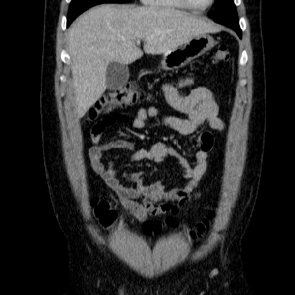 File:Acute appendicitis (Radiopaedia 38255-40270 Coronal C+ portal venous phase 26).jpg