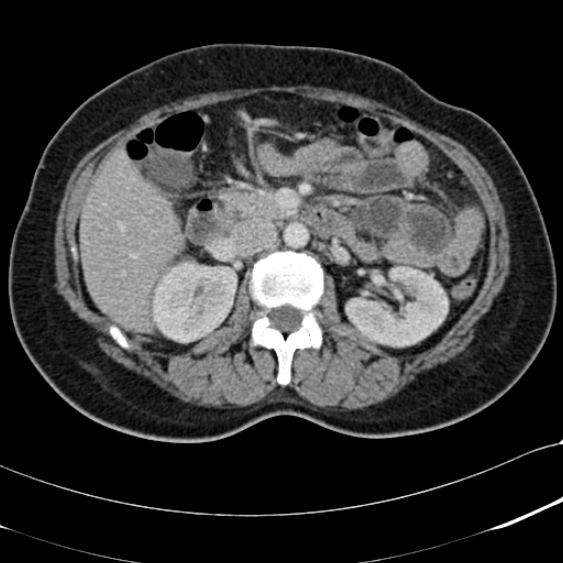 File:Acute appendicitis (Radiopaedia 48792-53822 Axial C+ portal venous phase 44).jpg