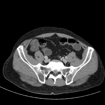File:Acute appendicitis (Radiopaedia 66513-75790 Axial C+ portal venous phase 67).jpg