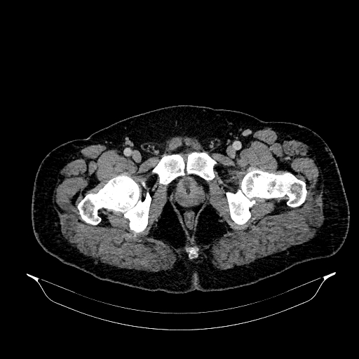 File:Acute appendicitis (Radiopaedia 79950-93224 Axial C+ portal venous phase 100).jpg