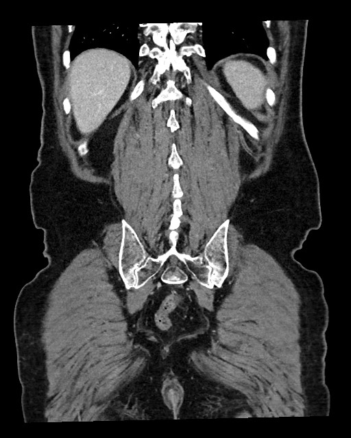 Acute appendicitis - large appendicoliths (Radiopaedia 61805-69820 Coronal C+ portal venous phase 112).jpg