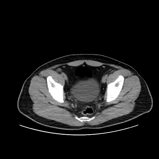 Acute appendicitis and COVID 19 pneumonia (Radiopaedia 76604-88380 Axial non-contrast 111).jpg