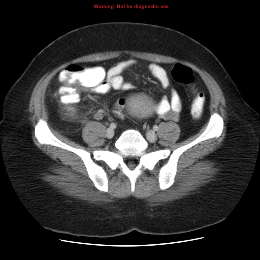 Acute appendicitis complicated by ovarian vein thrombophlebitis (Radiopaedia 16172-15851 Axial C+ portal venous phase 66).jpg
