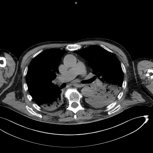 Acute aspiration pneumonitis (Radiopaedia 55642-62166 Axial liver window 30).jpg