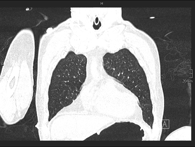 Acute aspiration pneumonitis (Radiopaedia 55642-62166 Coronal lung window 21).jpg