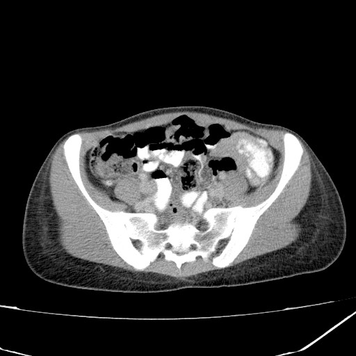 Acute bilateral pyelonephritis (Radiopaedia 74153-84969 Axial C+ portal venous phase 37).jpg