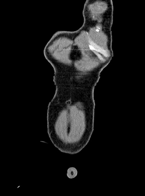 Acute bowel ischemia (Radiopaedia 87695-104114 Coronal C+ portal venous phase 64).jpg