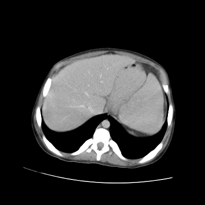 File:Acute calculous cholecystitis in patient with osteopetrosis (Radiopaedia 77871-90159 Axial C+ portal venous phase 21).jpg